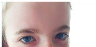 Littekens in het gezicht behandelen