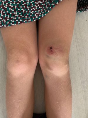 dikke knie lenthe na aanrijding sept 2020