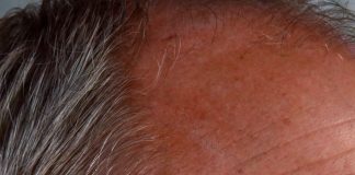 Waarom steeds meer mannen kiezen voor selfcare en een haarkliniek bezoeken haarkliniek bezoeken