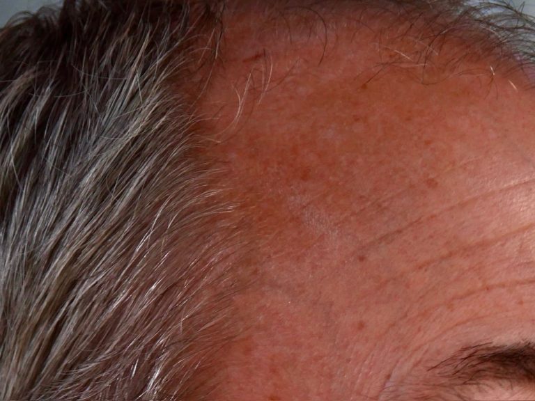 haarkliniek bezoeken